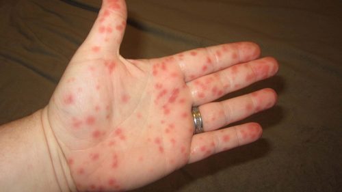 Các vết bầm dưới da là một trong những dấu hiệu nhận biết bệnh sốt xuất huyết