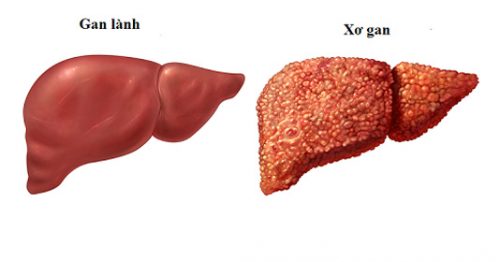 Xơ gan là một trong những biến chứng do nhiễm virut viêm gan 