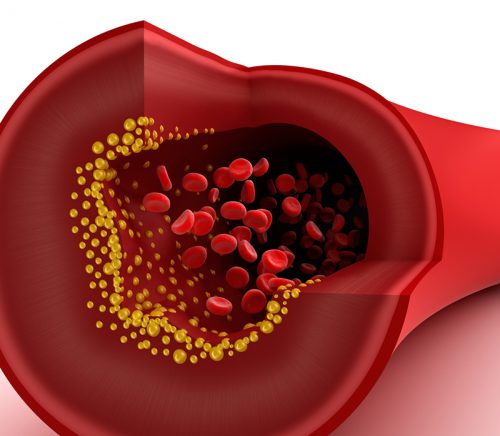 Cholesterol là một trong những nguyên nhân chính gây ra xơ vữa động mạch