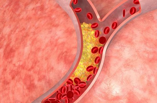 Rối loạn mỡ máu có thể gây nên chứng xơ vữa. tắc mạch máu