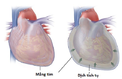 Tràn dịch màng ngoài tim có thể gây suy tim hoặc tử vong
